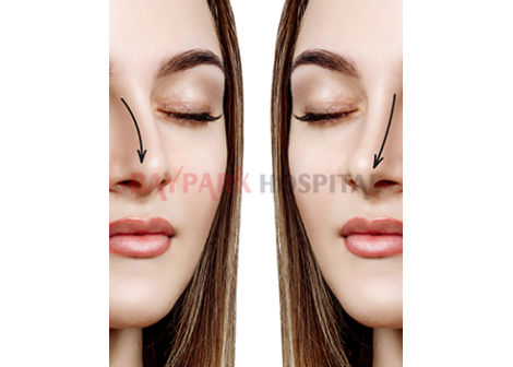 Rinoplasti (Burun Estetiği)